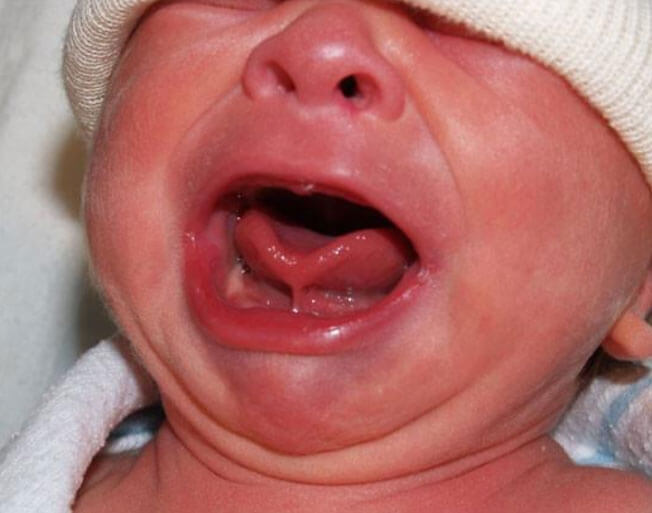 close up of a baby with a tongue tie