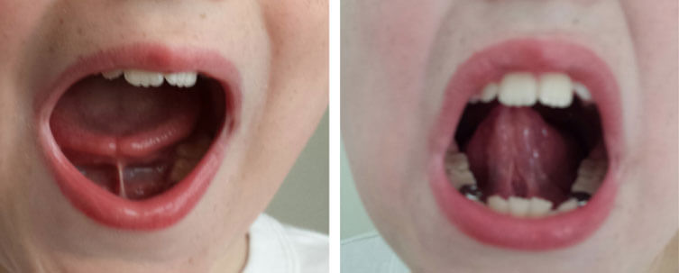 two pictures of tongue ties in children