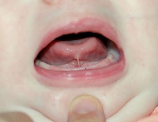picture of a lingual frenulum in a child