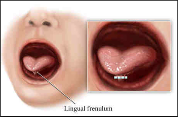 diagram showing how a lingual frenulum affects movement of the tongue
