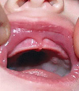 a child's mouth showing a lip tie