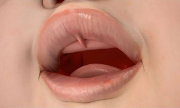 digital image showing a lip tie