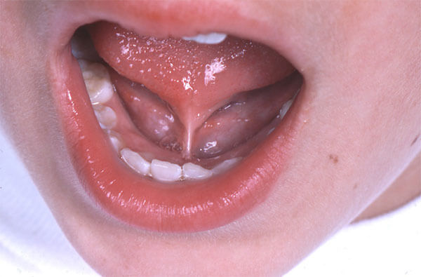 picture of a tongue tie in a young child